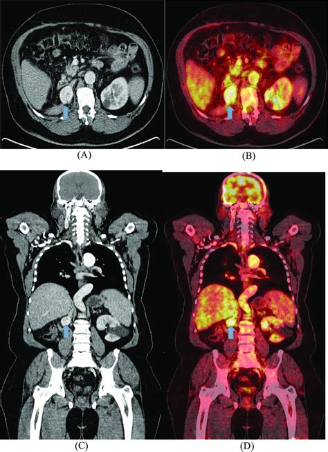 Male Patient Aged Sixty Five Years Old With Pathologically Proved Right