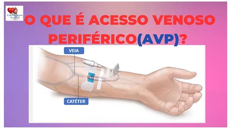 O Que Acesso Venoso Perif Rico Avp Atividade Importante Na