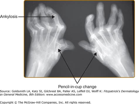 Psoriatic Arthritis Pencil In Cup Psoriatic Arthritis Pencil In Cup