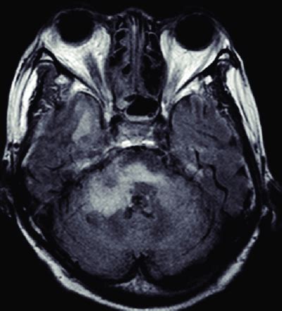 Brain T2 FLAIR Magnetic Resonance Images Revealed Multifocal Lesions