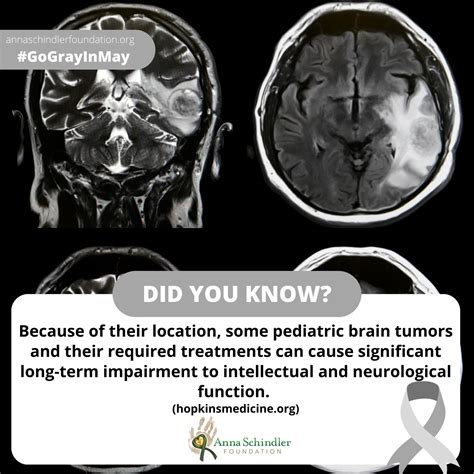 #GoGrayInMay to raise... - The Anna Schindler Foundation | Facebook