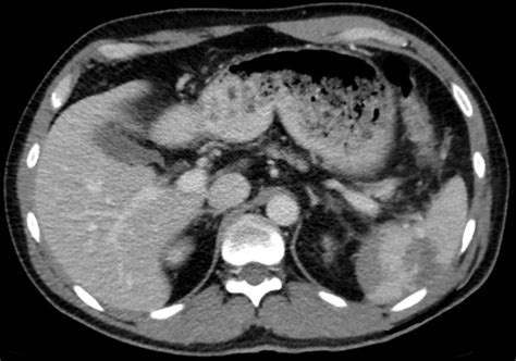 The Symptoms and Causes of a Ruptured Spleen - The Thistle Law Firm