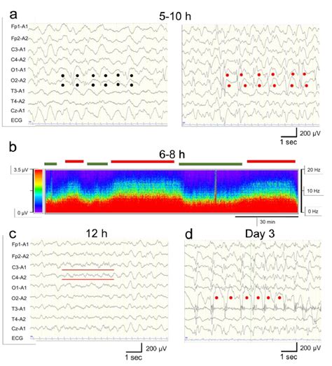 Electroencephalogram Eeg Findings A Eeg Findings 9 H After The