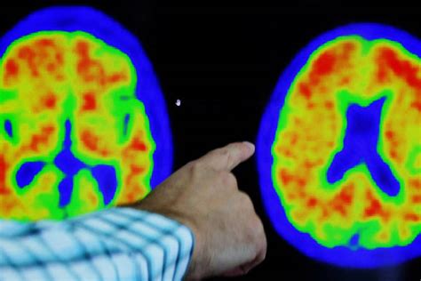 Alzheimer Cientistas Descobrem Que H Tipos Da Doen A