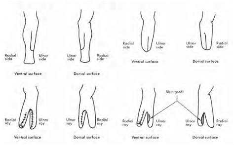 Figure 2 from Rehabilitation of the bilateral below-elbow amputee by ...