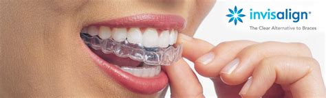 Invisalign Nevidni Zobni Aparat