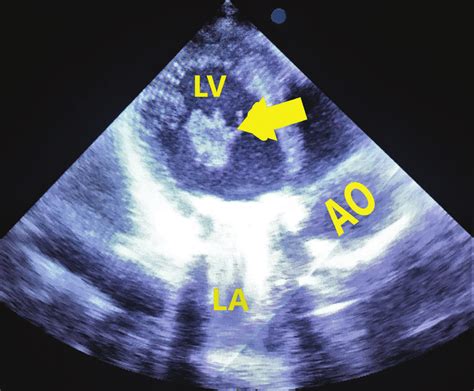 Postoperative Rd Day Transthoracic Echocardiography Apical Three