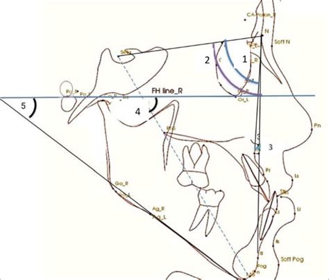 Skeletal Angular Measurement 1 Sna 2 Snb 3 Anb 4 Y Axis And 5 Fm Download Scientific