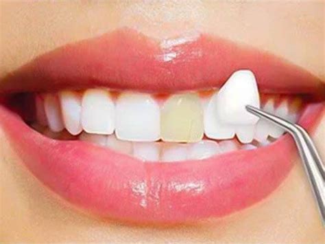 Composite Veneers Pros And Cons Procedure And Cost Affordable Dental