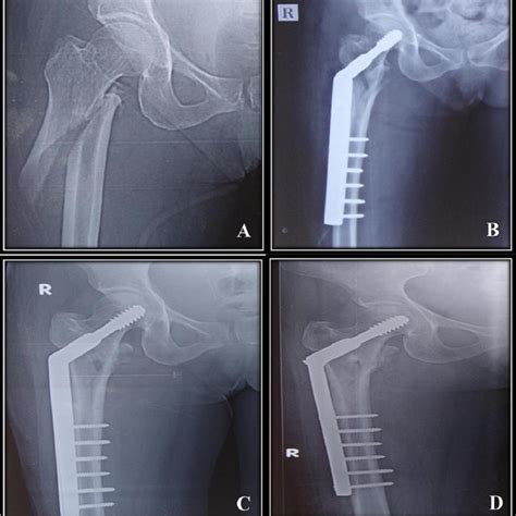 Pre Operative And Post Operative Follow Up Radiographs Of An