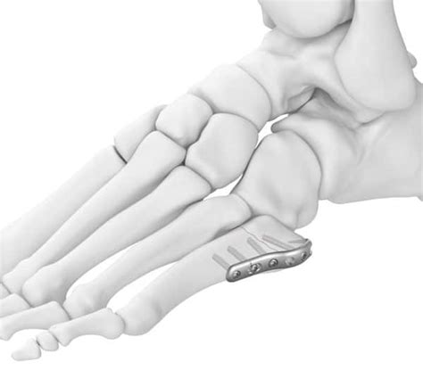 Jones Fracture Plate 5th Metatarsal Implant Trimed Inc