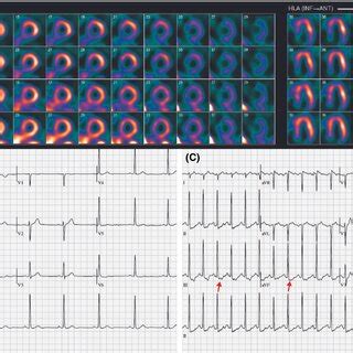 Exercise Electrocardiographic And Spect Findings In Patient Panel A