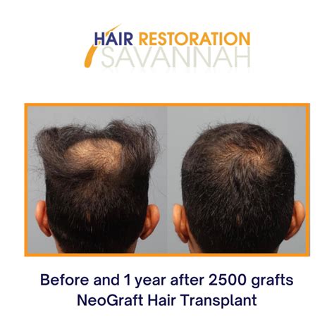 Male Hair Loss Solutions At Hair Restoration Savannah