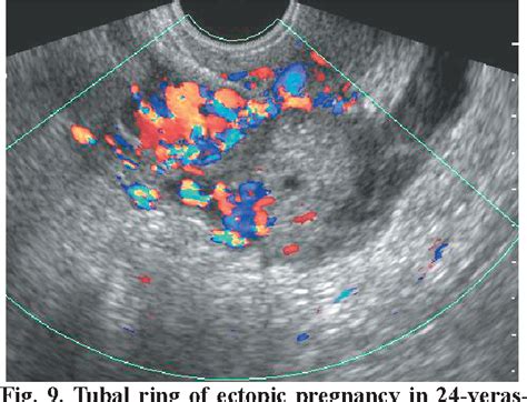 Figure 10 From Tubal Ring Sign Of Ectopic Pregnancy Versus Corpus Luteum Cyst Best Sonographic