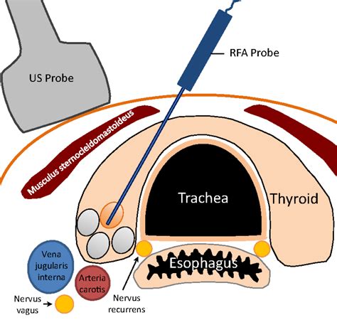 Thyroid RFA vs. Conventional Thyroidectomy