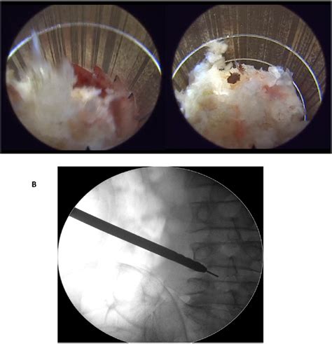 Figure From Comparing The Surgical E Cacy Of A Newly Designed