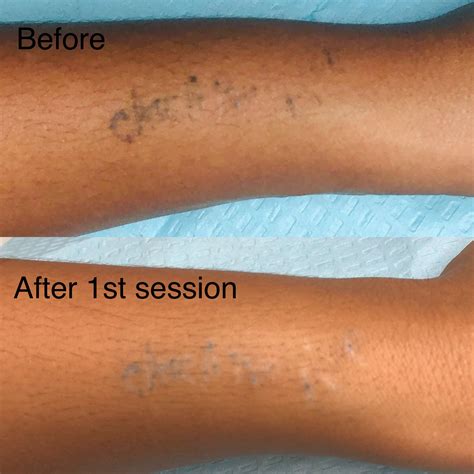 Details 67 Laser Tattoo Removal Dark Skin Super Hot In Cdgdbentre