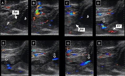 Analysis Of Human Ejaculation Using Color Doppler Ultrasonography A