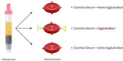 Der Antikörpersuchtest Transfusionsmedizin