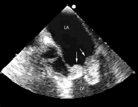 Echocardiography In Infective Endocarditis Heart