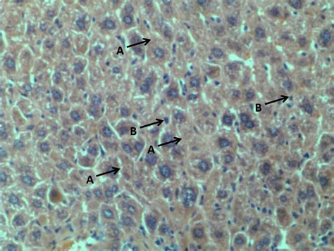 Liver Parenchyma Demonstrated Hypertrophy Of Liver Cells Akupffer