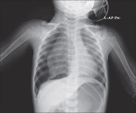 Chest X-ray at admission shows right pneumothorax, pneumomediastinum ...