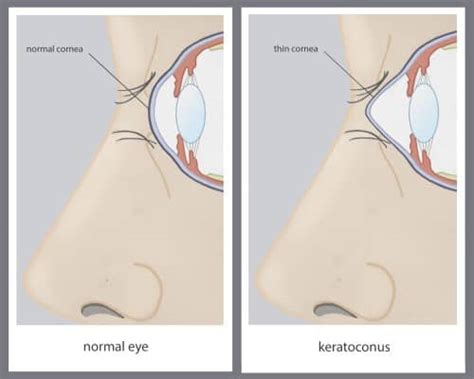 Cornea Transplant Why Done Recovery Results And Prices