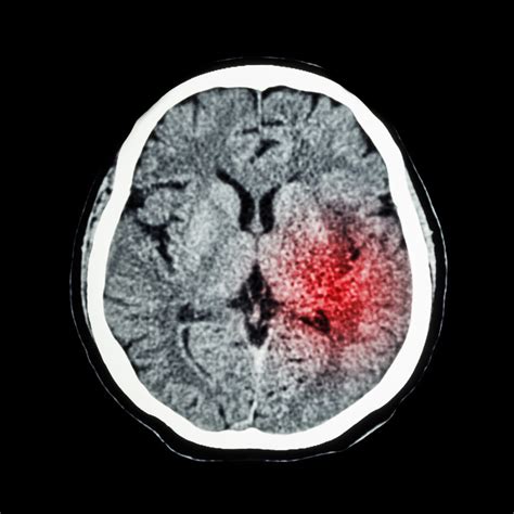 CT scan of brain show Ischemic Stroke or Hemorrhagic Stroke ...