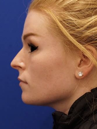 Liquid Rhinoplasty Archives Mao Facial Plastics