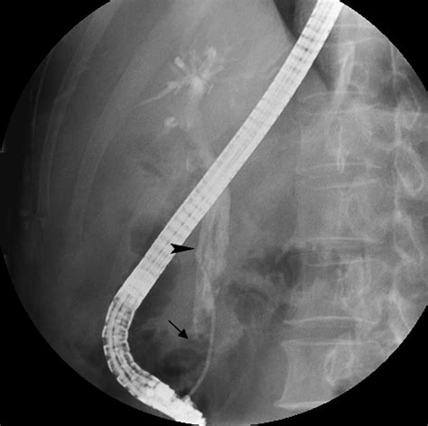 Biliary Obstruction Caused By Hemobilia After Endoscopic Sphincterotomy