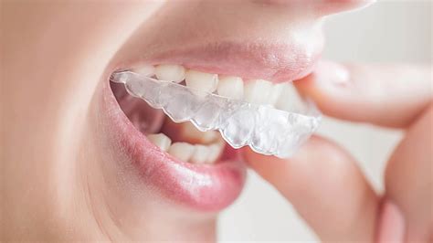 Aparat Invisalign Aparaty Prze Roczyste Niewidoczne Nak Adki Na Z By