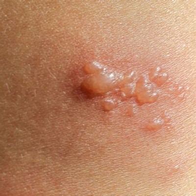 Bullous Pemphigoid Nicole Decamp Pc Oklahoma City Ok Dermatologist