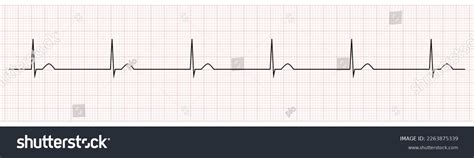 Ekg Monitor Showing Junctional Escape Rhythm Stock Vector (Royalty Free ...