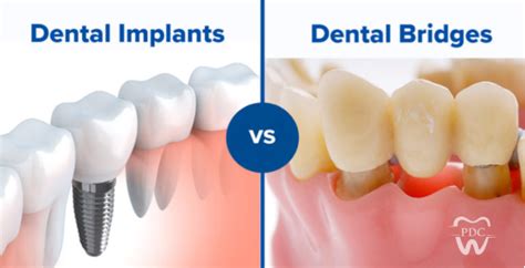 Dental Implant Vs Crown Bridge Finding Whats Best For You Prakash