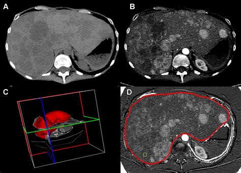 Volumetric Enhancing Tumor Burden At CT To Predict Survival Outcomes In