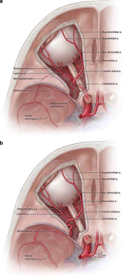 Illustrations Depict Normal And Variant Ophthalmic Artery Origins The