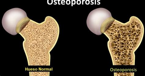 Osteoporosis Y Osteopenia