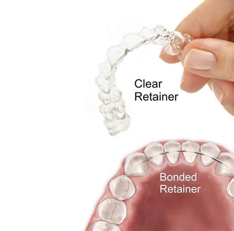 What is the difference between fixed retainer and removable retainer ...