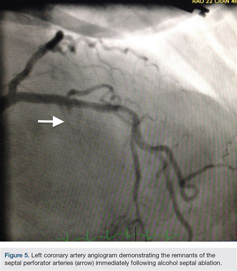 Alcohol Septal Ablation as a Percutaneous Therapy for Symptomatic