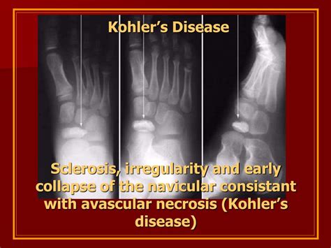 osteochondroses   foot powerpoint