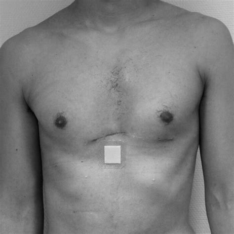 Pectus excavatum Dr Amandine Bonte Chirurgie plastique esthétique