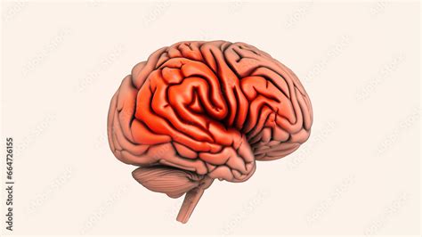 The cause of hemorrhagic stroke is brain hemorrhage Stock Illustration ...