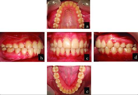 Mid Treatment Intraoral Photographs With Forsus Frd A Anterior View