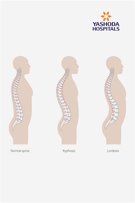 Kyphosis of the Spine: What is Kyphosis of the Spine, its Causes ...