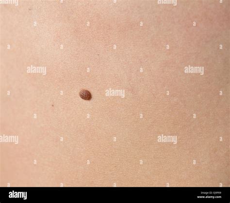 Birthmark Stock Photos And Birthmark Stock Images Alamy