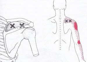 Supraspinatus Triggerpoint On Sale Emergencydentistry