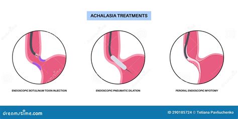 Achalasia Treatments Procedures Stock Illustration Illustration Of