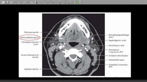 CT anatomy of Neck Spaces RV