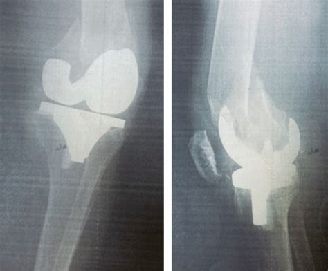 Fractura Periprot Sica De Rodilla Importancia Del Protocolo Prequir Rgico