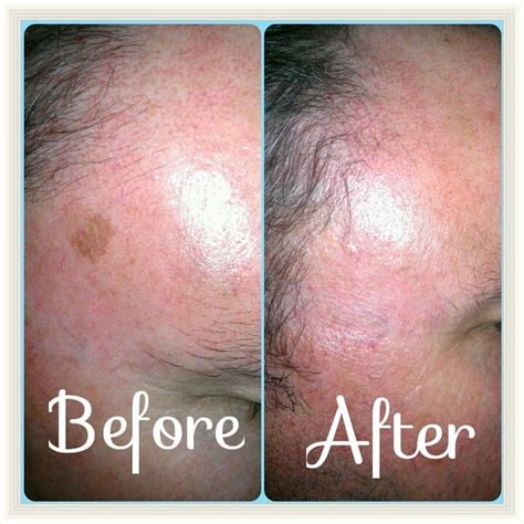 removal of minor skin irregularities